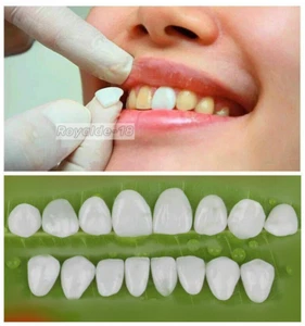 Anterior Teeth Veneer Dental Tooth Whitening Veneers SL Ceramic 3Size 12Position - Picture 1 of 23