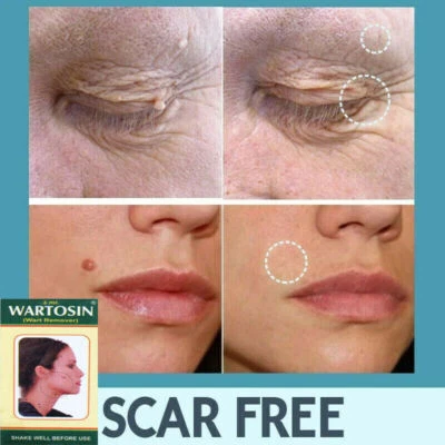 WARTOSIN NEW SKIN TAG REMOVER CREAM SAFE FAST WART REMOVAL MOLE ACNE PIMPLE PATCH SPOT UK