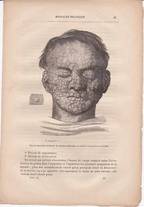 Ancienne gravure médicale 11 - Médecine pratique & populaire - Tête de varioleux - Picture 1 of 1