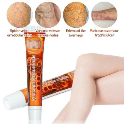 MARKENLOS Herbal Medical Gips Krampfadern Salbencreme Bein Vaskulitis entfernen Creme