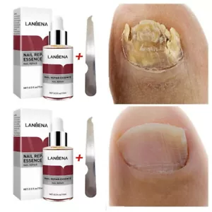 2x Nail Repair Serum Fungal Nail Treatment Liquid Remove Toe Nail Fungus Essence - Picture 1 of 13