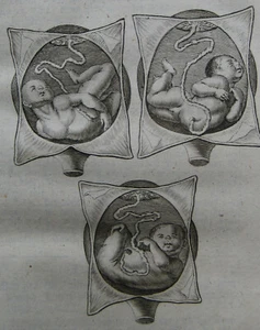 Johannes Fatio, Geburtshilfe, Wehe-Mutter, 1752 - Bild 1 von 14