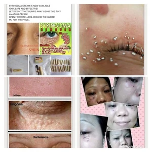 Syringoma Remover 2ml With Free Kasoy Oil Authentic Safe Effective - Picture 1 of 12