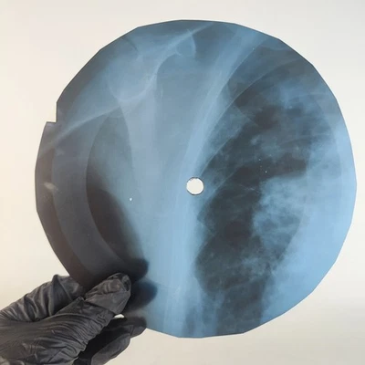 DAVID BOWIE THE SUPEMAN X-Ray USSR Record Roentgen Bone Ribs Music Vinyl - Image 1 of 2