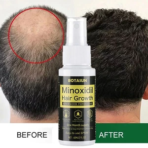 Extra Starke MINOXIDIL 5% Haarwachstum Behandlung Spray Serum FÜR Männer 60ml - Bild 1 von 19