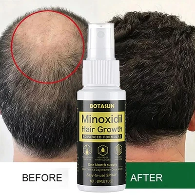 BOTASUN Extra Starke MINOXIDIL 5% Haarwachstum Behandlung Spray Serum FÜR Männer 60ml
