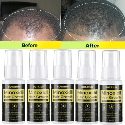 BOTASUN Minoxidil 5% Haarwachstum Serum Spray für Männer Haarwuchsmittel 5 Monats-Vorrat