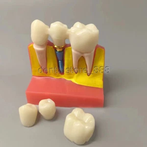 Analyse d'implant dentaire pont couronne démonstration dents modèle Typodont - Photo 1/5