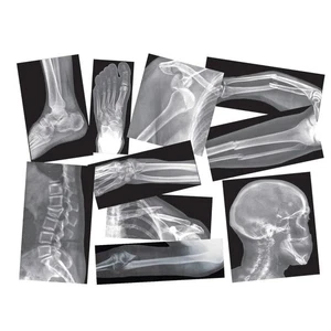 Roylco Broken Bones X-Rays - Picture 1 of 5