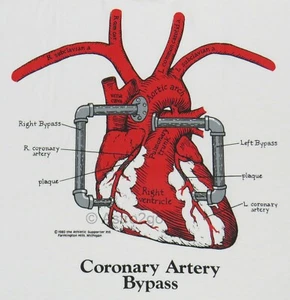 CORONARY ARTERY BYPASS-Leslie Arwin Heart Disease Anatomy Biology T shirt S-2XL - Picture 1 of 2