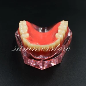 #6001 Dental Restoration Overdenture 4 Implant Study Demo Upper Teeth Model Pink - Picture 1 of 10