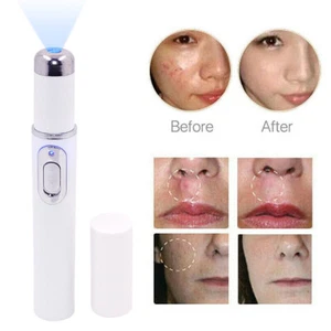 Blue Light Therapy Pen for Spider Veins Acne Removal Pen Scar Wrinkles Remover - Picture 1 of 10
