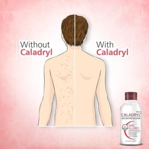 (Pack of 3) Caladryl Skin Allergy Expert Lotion (3 x 125 ml) For Skin Problems - Picture 1 of 7