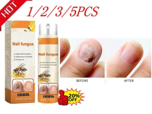 1-5 Stück*200ml Nagelpilz Beruhigungsspray b8hs - Bild 1 von 16