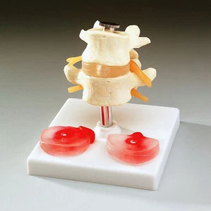 Lumbar Vertebrae w/ Herniated Disc Anatomical Spine NEW - Picture 1 of 1