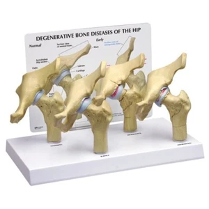 HipJoint Osteoartrite GPI Set anatomico di 4 LFA#1320 Faici un'offerta VIDEO - Foto 1 di 6