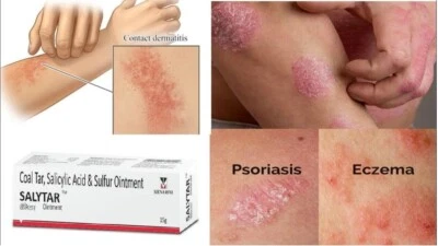 MENARINI Coal Tar & Salicylic Acid Ointment (15gm) for Psoriasis,Eczema & Other Skin Care