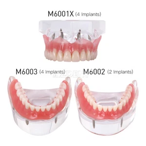 Dental Overdenture Restoration Implant/Typodont Model With Removable Teach Study - Picture 1 of 14