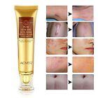 TCM Scar and Acne Marks Removal Cream Burns Cuts Stretch Marks Treatment Cream
