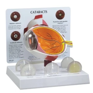 Cataract Eye Set of Five Lens Anatomical Model LFA#2800 SEE VIDEO Make an Offer! - Picture 1 of 4
