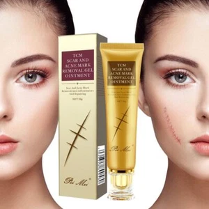 ✅30g Acne Scar Removal Cream Pimples Stretch Marks Nice Remove Gel F1H1 - Bild 1 von 9