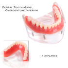 Dental Teeth Model Overdenture Inferior with 4 Implants Demo Fit Dental 1 Set