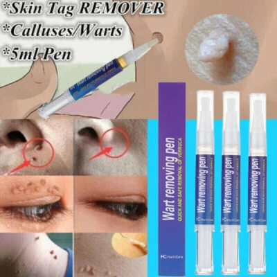 3PACKS 12 Hours Wart Remover Pen Skin Tag Mole Remover Eliminate Foot Corn Warts