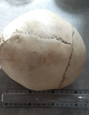 Crane humain ancien env 1900 Medecine Hydrocephale? Cabinet Reflexion. - Photo 1/4