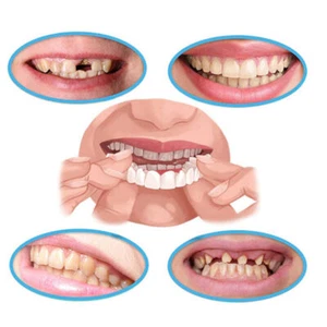 Smile Snap On False Teeth Upper Lower Dental Veneers Dentures Tooth Cover 4X Set - Picture 1 of 8