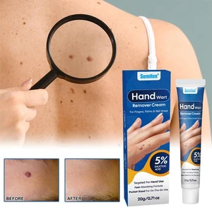 Entfernung Warzencreme%2C Warzenentfernung Salicylsäure Warzencreme%2C♈ - Bild 1 von 18