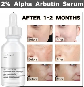 Alpha Arbutin + Hyaluronic Acid Moisturizing Serum for Acne & Fine Lines - 30ml - Picture 1 of 10