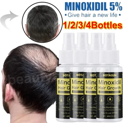 Paquete de 1-4 Minoxidil 5% Extra Fuerza Hombres Solución para Regeneración del Cabello Suministro para 4 Meses Foto 1 de 4