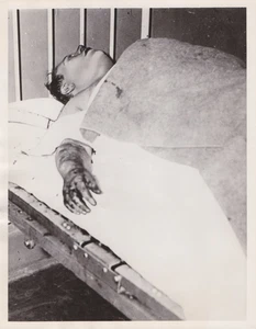 1935 Press Photo Bodyguard Otto Berman of Mobster Dutch Shultz Shot Dead in NJ - Picture 1 of 2