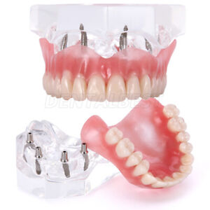 Dental Implant Teeth Model Demo Overdenture Restoration With 4 Implants Upper