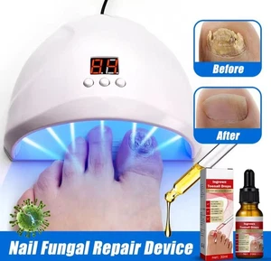 Nagel pilz Laser behandlungs gerät ReparaturAnti-Infektion Paronychie Onycho... - Bild 1 von 6