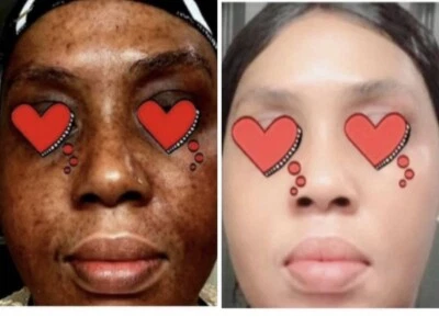 FAST Skin Whitening Bleaching Cream Lightening AHA