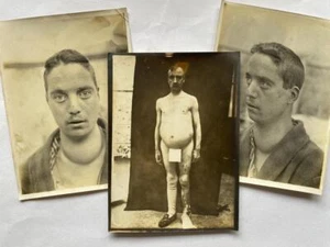3 Interesting Original 1800s/1900s Photographs of Medical Conditions - Picture 1 of 4