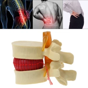 Modelo de columna lumbar degenerativa de vértebras lumbares humanas anatómicas 1:1,5 amarillo - Imagen 1 de 14
