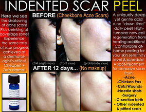 Indented Acne Scar Removal Peel Chicken Pox Ice pick Rolling Boxcar Scars 