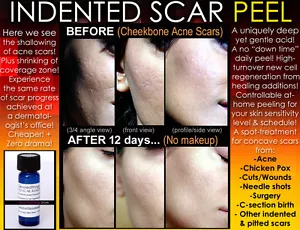 BEST Treatment for Indented Scars Acne Chicken Pox Pitted Scar Removal Peel - Picture 1 of 13
