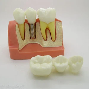 Dental Equipment Implant Analysis Crown Bridge Demonstration Teeth Teach Model  - Picture 1 of 4