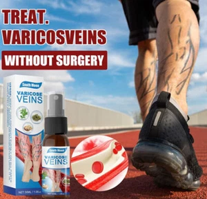 Spray de venas varicosas de 30 ml cuidado y reparación de venas spray tratamiento de venas - Imagen 1 de 6