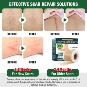 Soothing scar skin silicone scar tape scar care patch M7O1 S2O3 - Bild 1 von 10