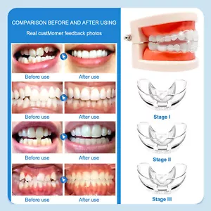 Apparecchio correttore denti ortodontico dentale invisibile 3 fasi fermo allineamento - Foto 1 di 29