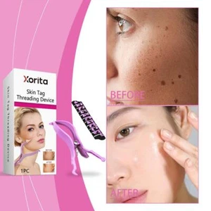 Skin Tag Threading Device Face Care Tool Improve Skin - Picture 1 of 18