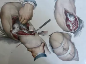 1850 Chirurgia Anatomia Amputation Di La Gamba Per Anca 1 Litografia - Imagen 1 de 3