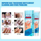 Nail Repair Cream Effective Nail Treatment Solution For Discolored IDS