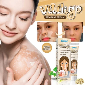 Treatment Moisturizing Cream White Spot Disease Vitiligo Balm Repair Ointment - Picture 1 of 8