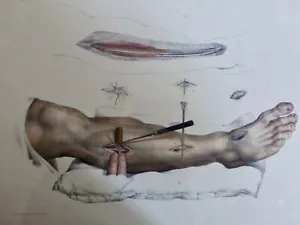 1850 Chirurgie Ligature de l'artère tibiale antérieure 1 LITHOGRAPHIE - Imagen 1 de 3