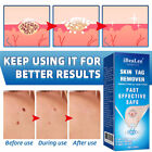 Skin Tag Remover Flat Wart Liquid Vulgaris Plantar Filamenous Wart Removal Uk